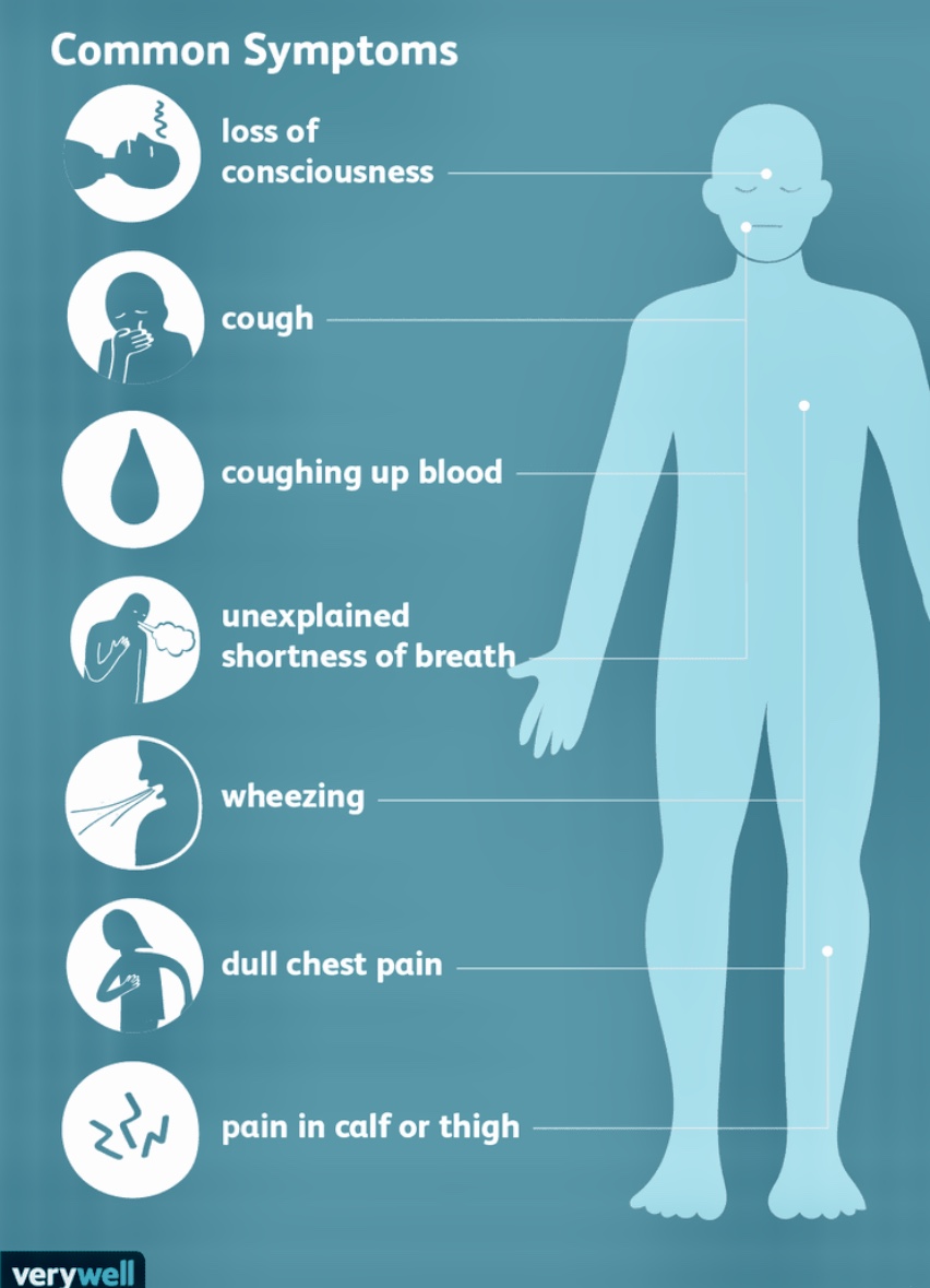 Pulmonary embolism: That blood clots in the lungs - HNL