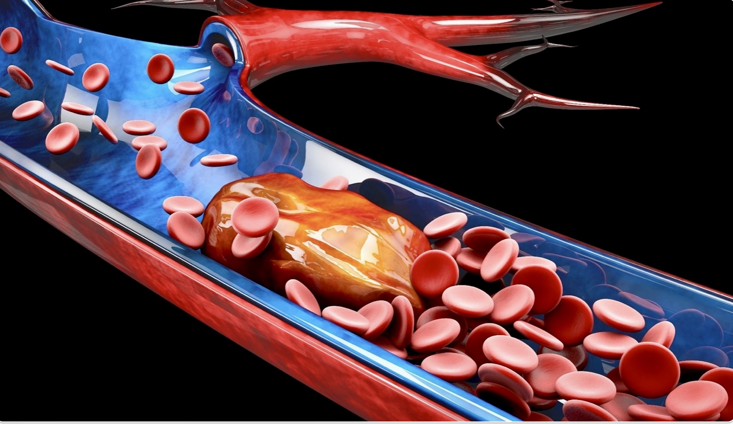 Pulmonary embolism: That blood clots in the lungs - HNL