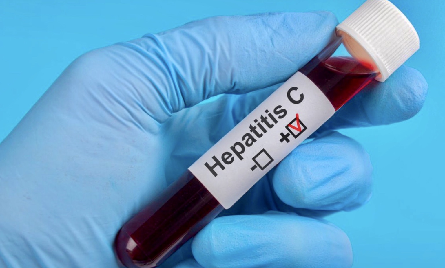 Hepatitis C: Enter the yellow dragon - HNL